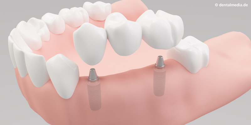Implantat Frankfurt