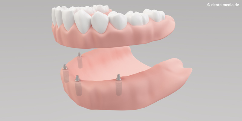 Zahnarzt Implantate Frankfurt